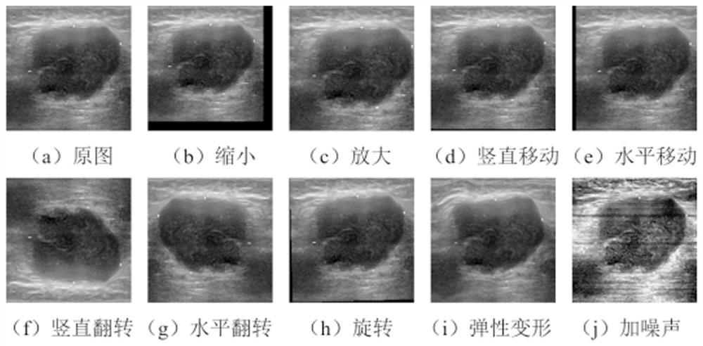 Breast ultrasonic image tumor classification method based on attention neural network