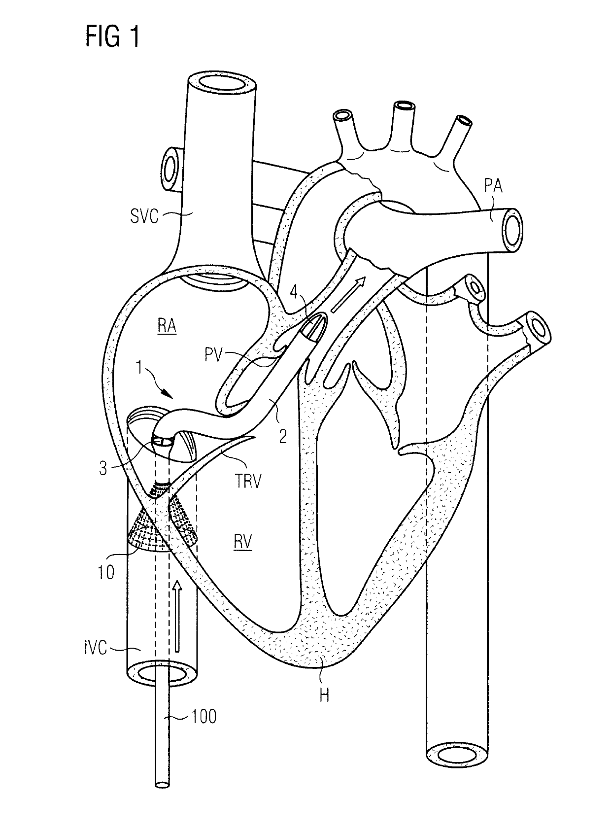 Blood pump with filter