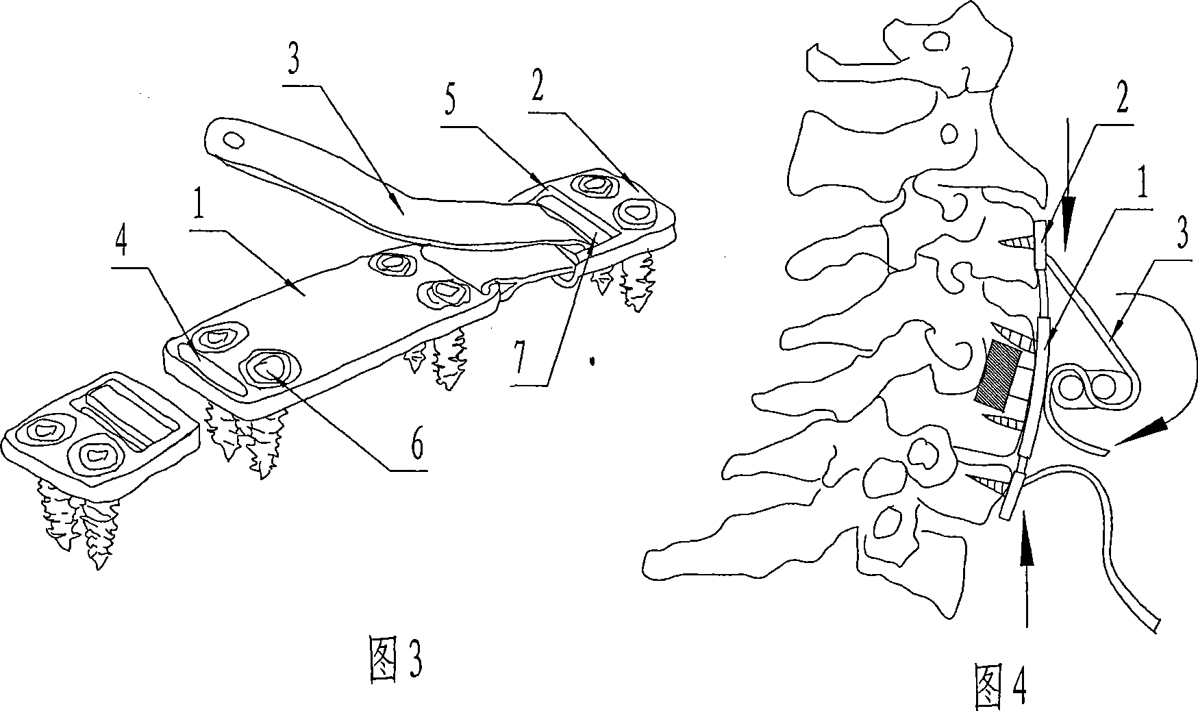 System for fixing anterior cervical and capable of preventing overcompensation movement
