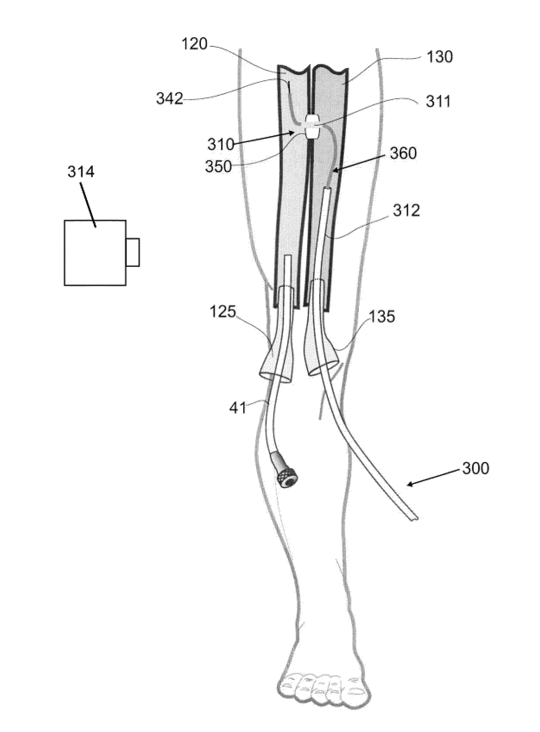 Devices, systems, and methods for peripheral arteriovenous fistula creation