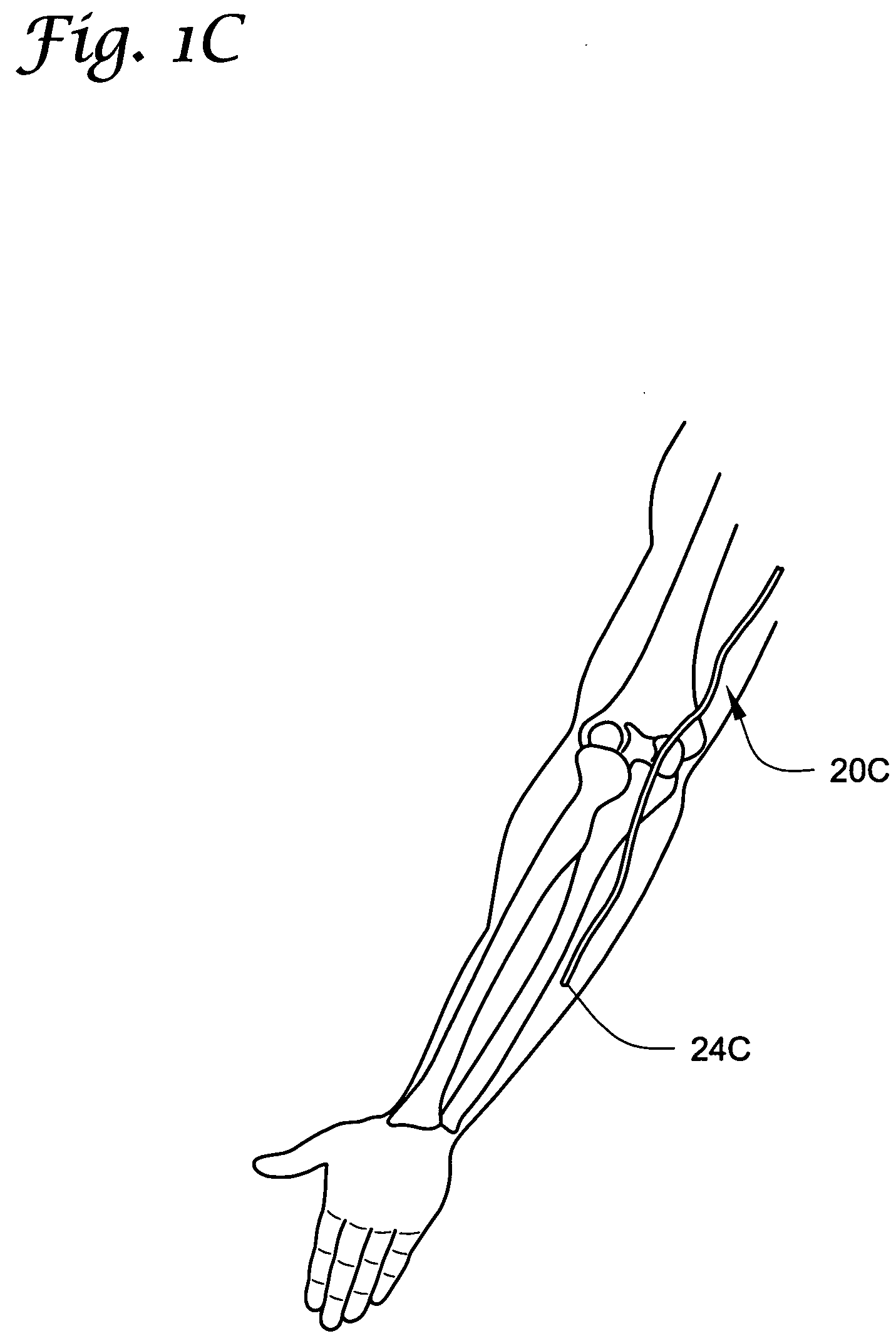 Catheters incorporating valves and permeable membranes