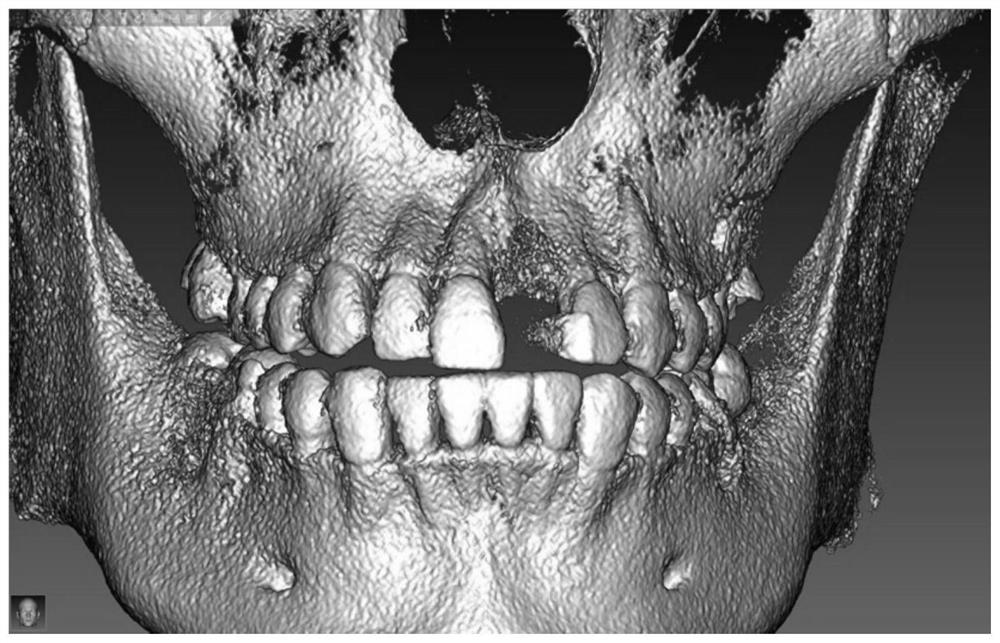 A personalized abutment-crown integrated temporary restoration and its preparation method and application