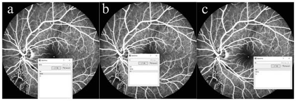 Algorithm for automatically identifying non-perfusion area of fundus fluorescence angiography image and recommending laser photocoagulation area