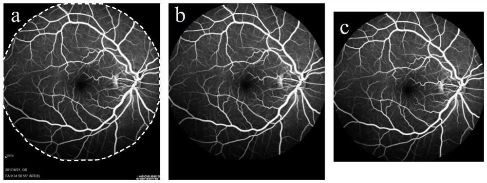 Algorithm for automatically identifying non-perfusion area of fundus fluorescence angiography image and recommending laser photocoagulation area