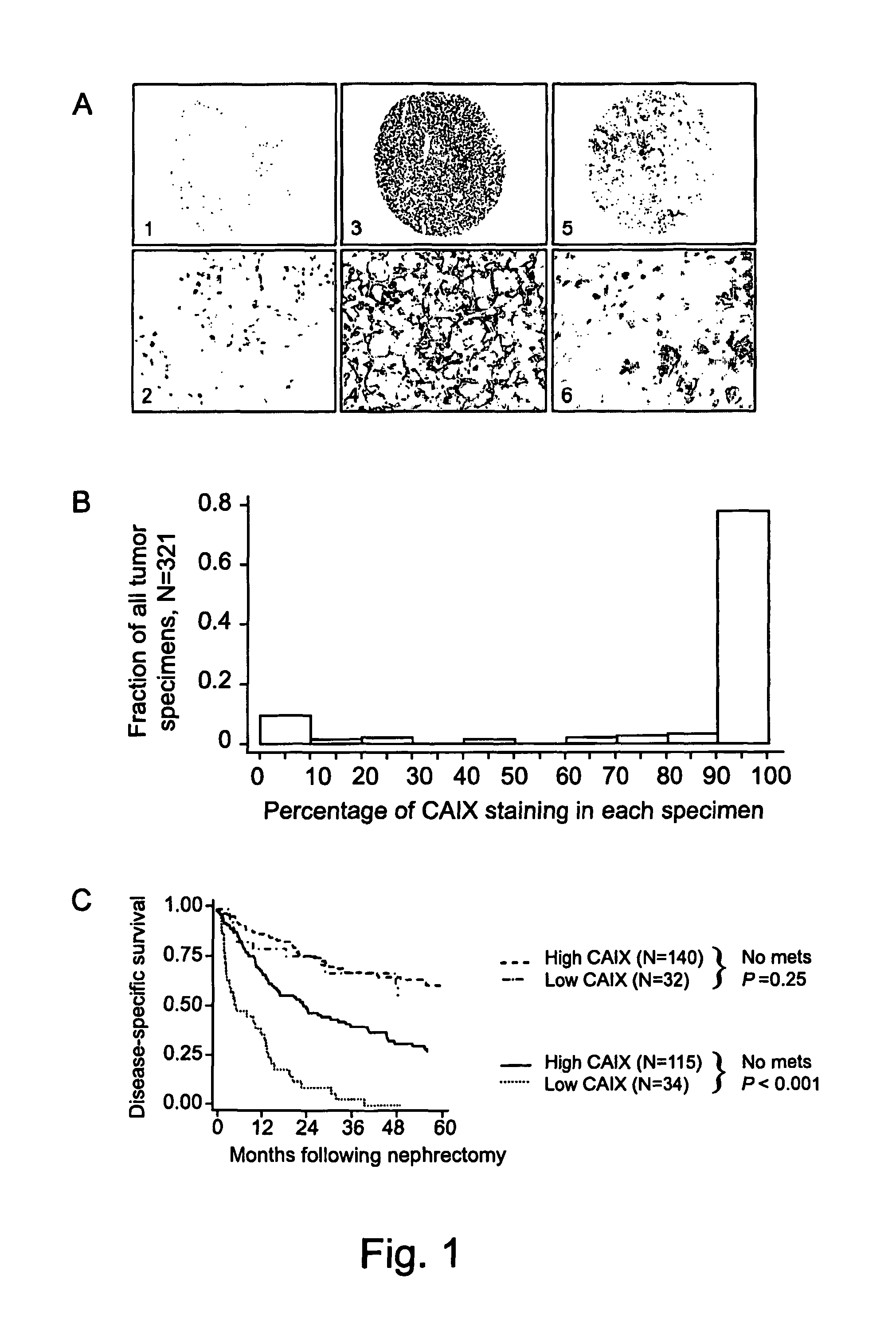 Methods of renal cell carcinoma prognosis and treatment selection with carbonic anhydrase IX