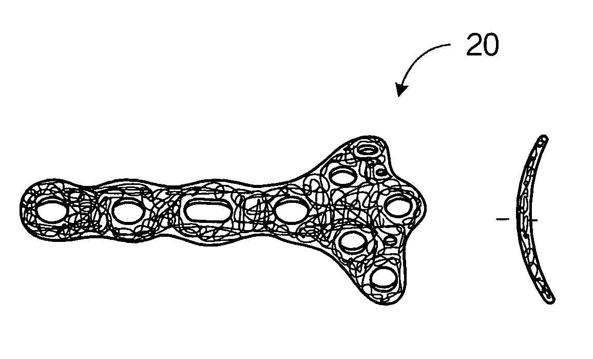 Interlaced wire for implants