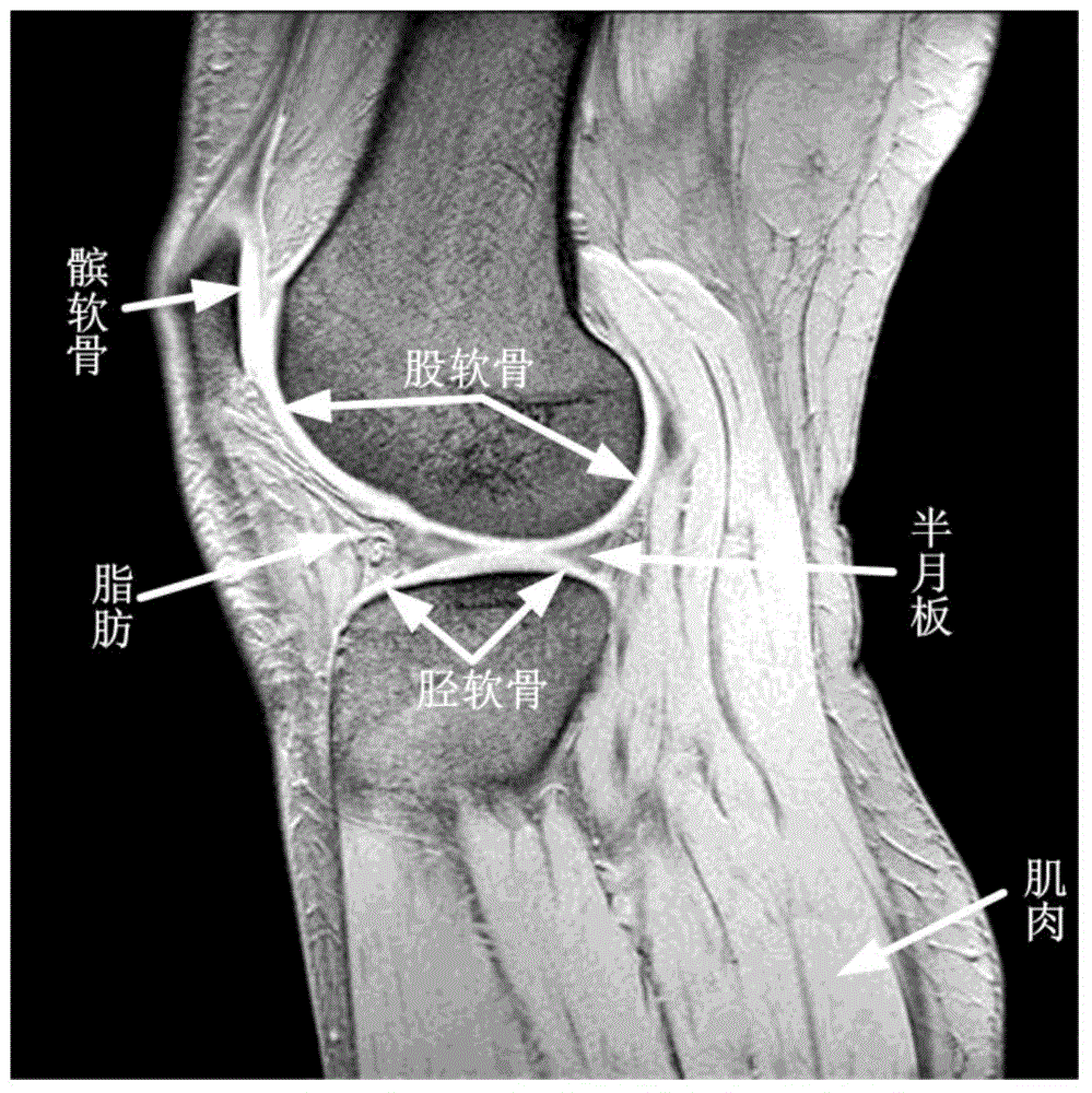 Automatic knee cartilage image partitioning method based on SVM (support vector machine) and elastic region growth