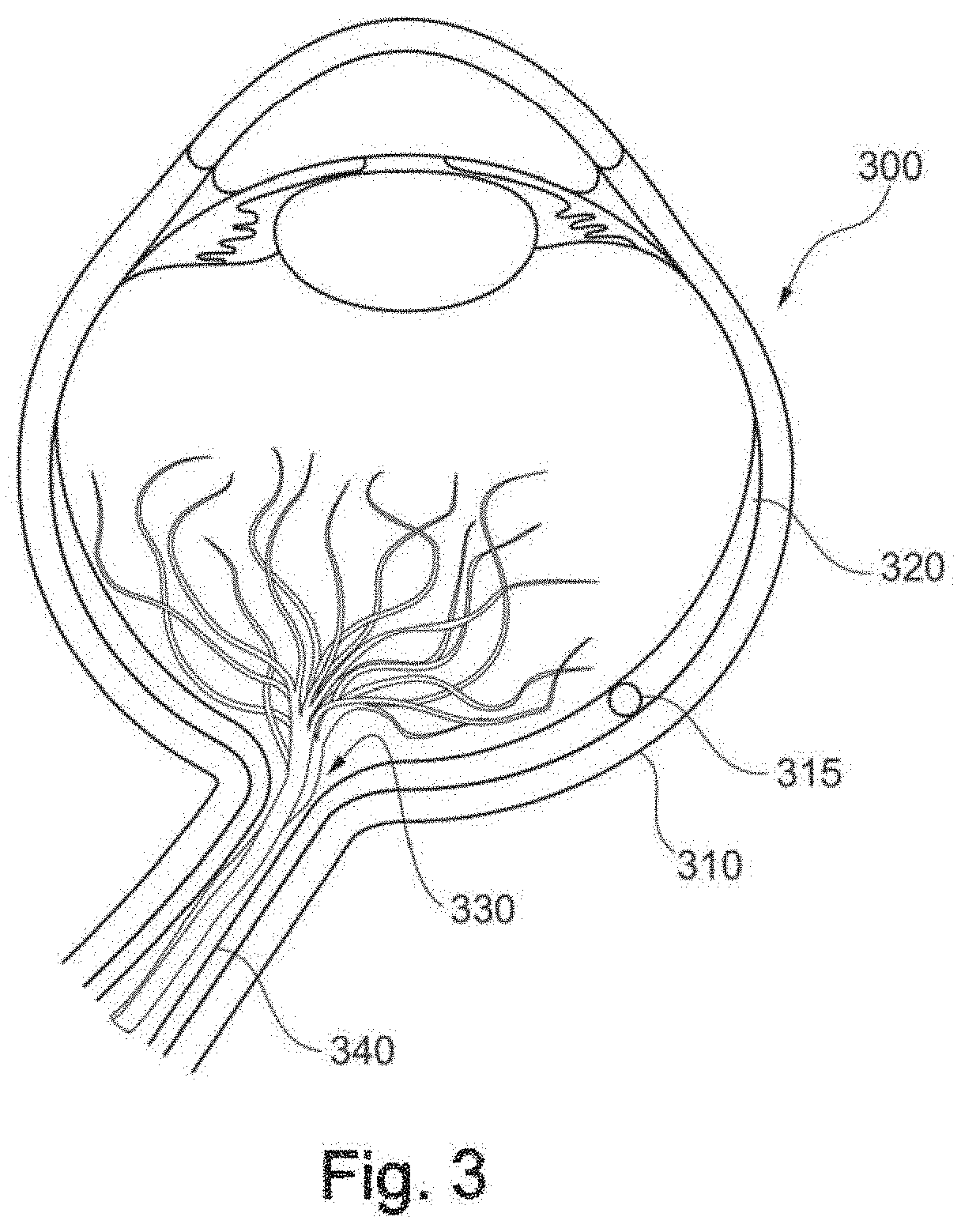 System and Method to stimulate the optic nerve