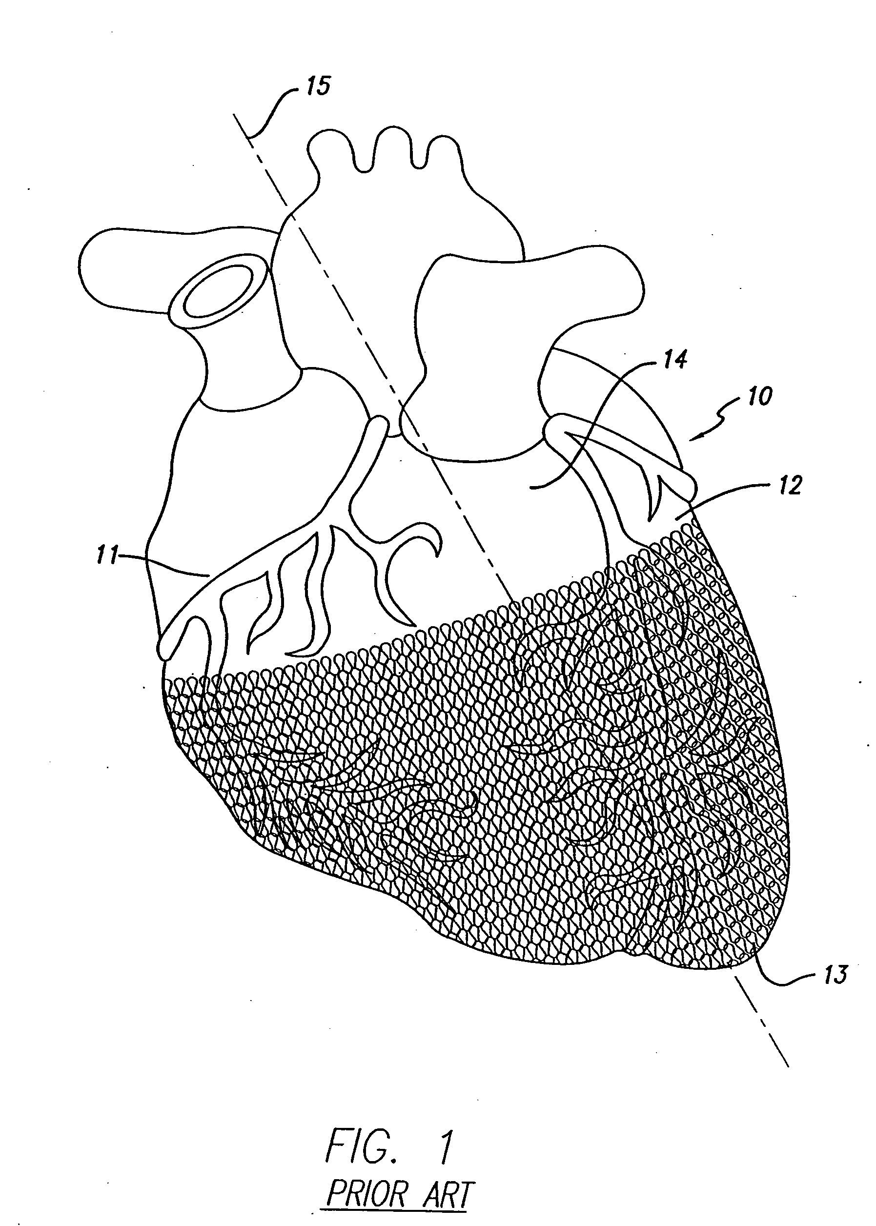 Delivery device for cardiac harness