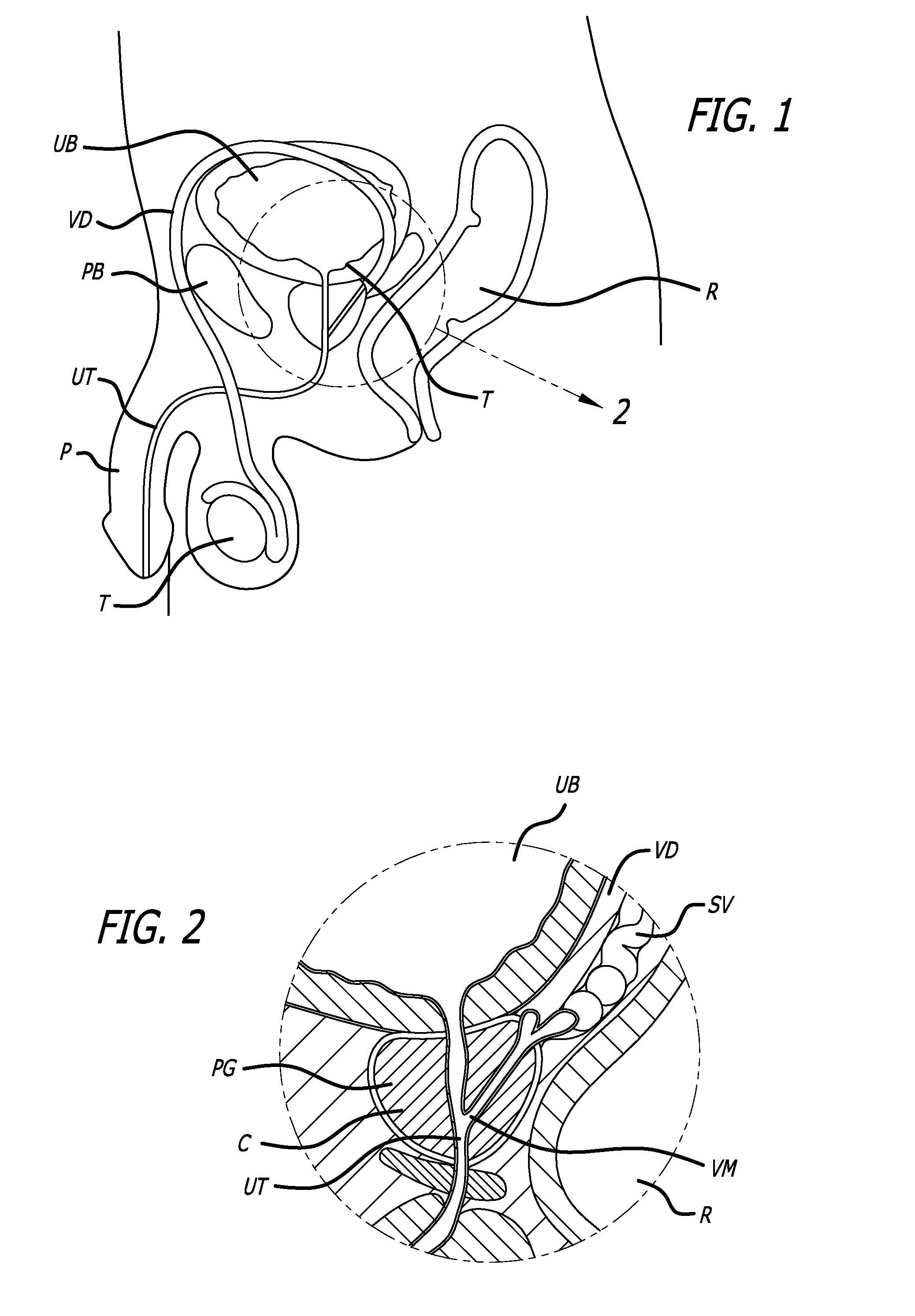 Flexible system for delivering an anchor