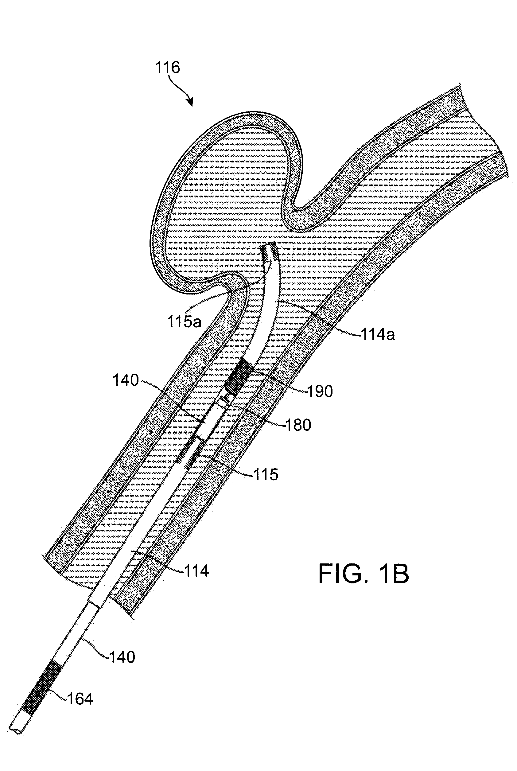 Implant, a mandrel, and a method of forming an implant
