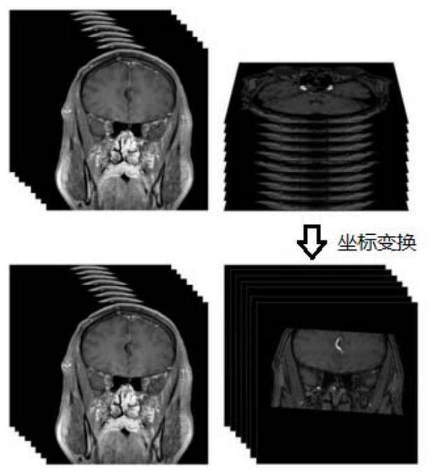 Blood vessel image flow void artifact elimination method