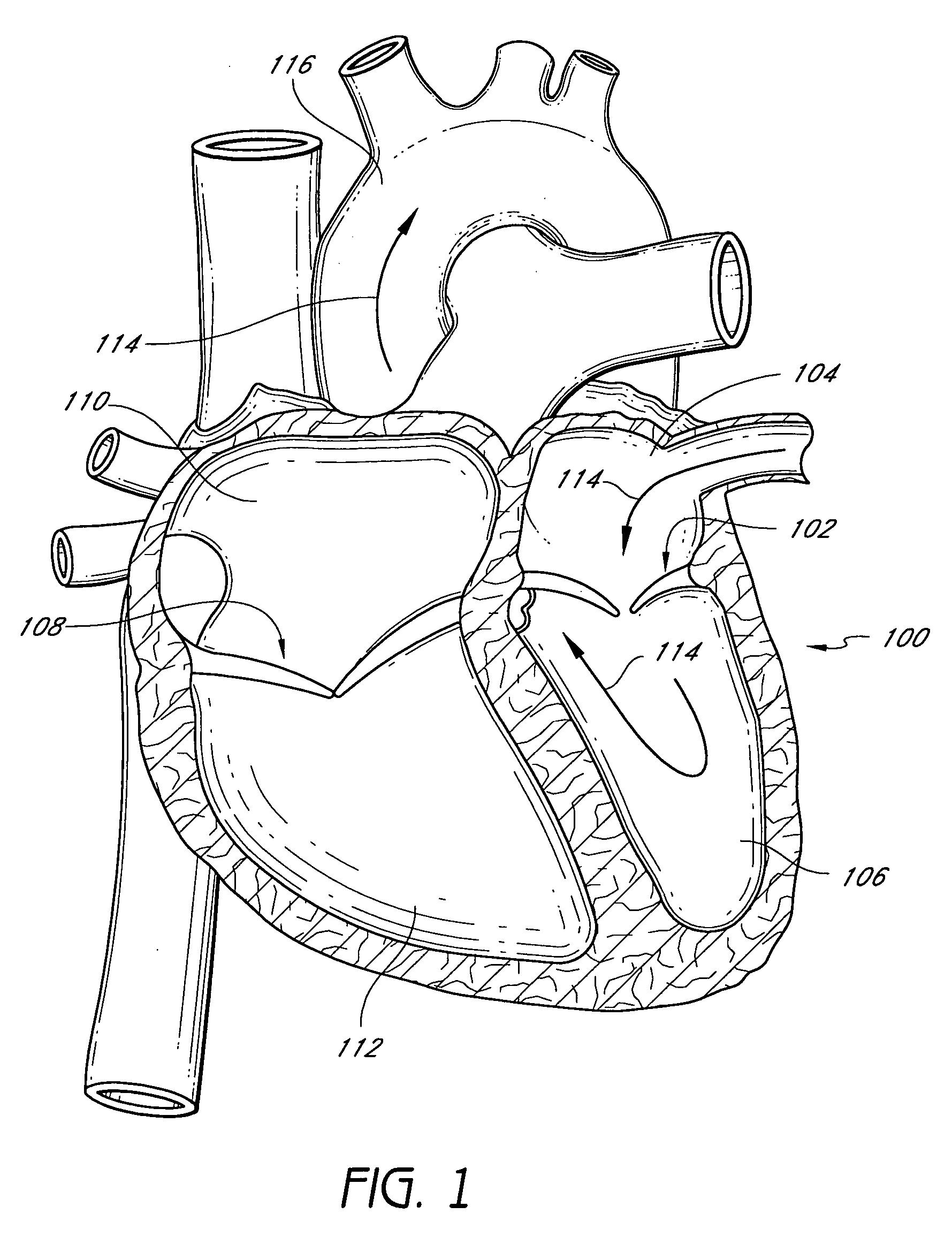 Implants and methods for reshaping heart valves