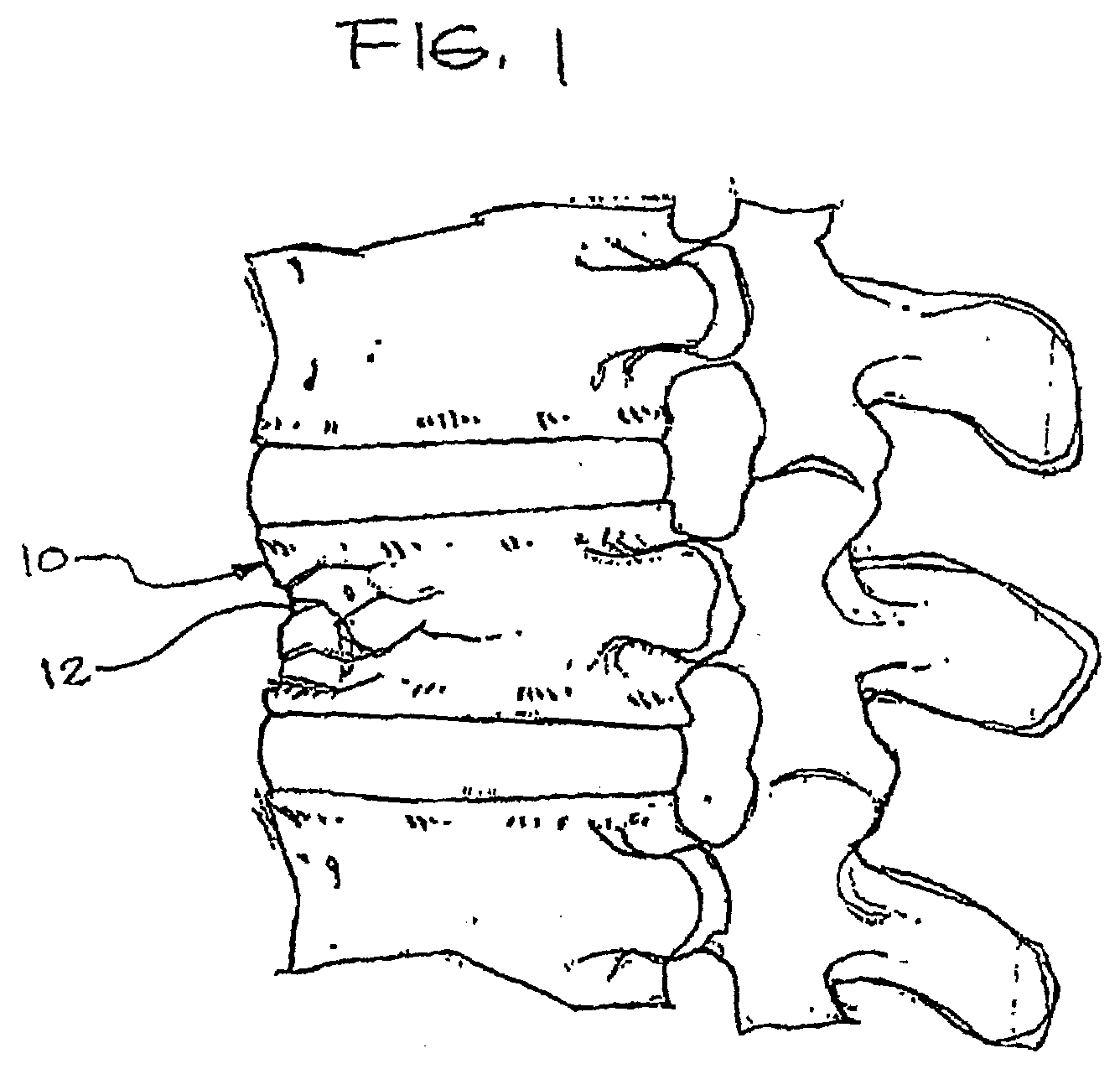 Expandable porous mesh bag device and methods of use for reduction, filling, fixation, and supporting of bone