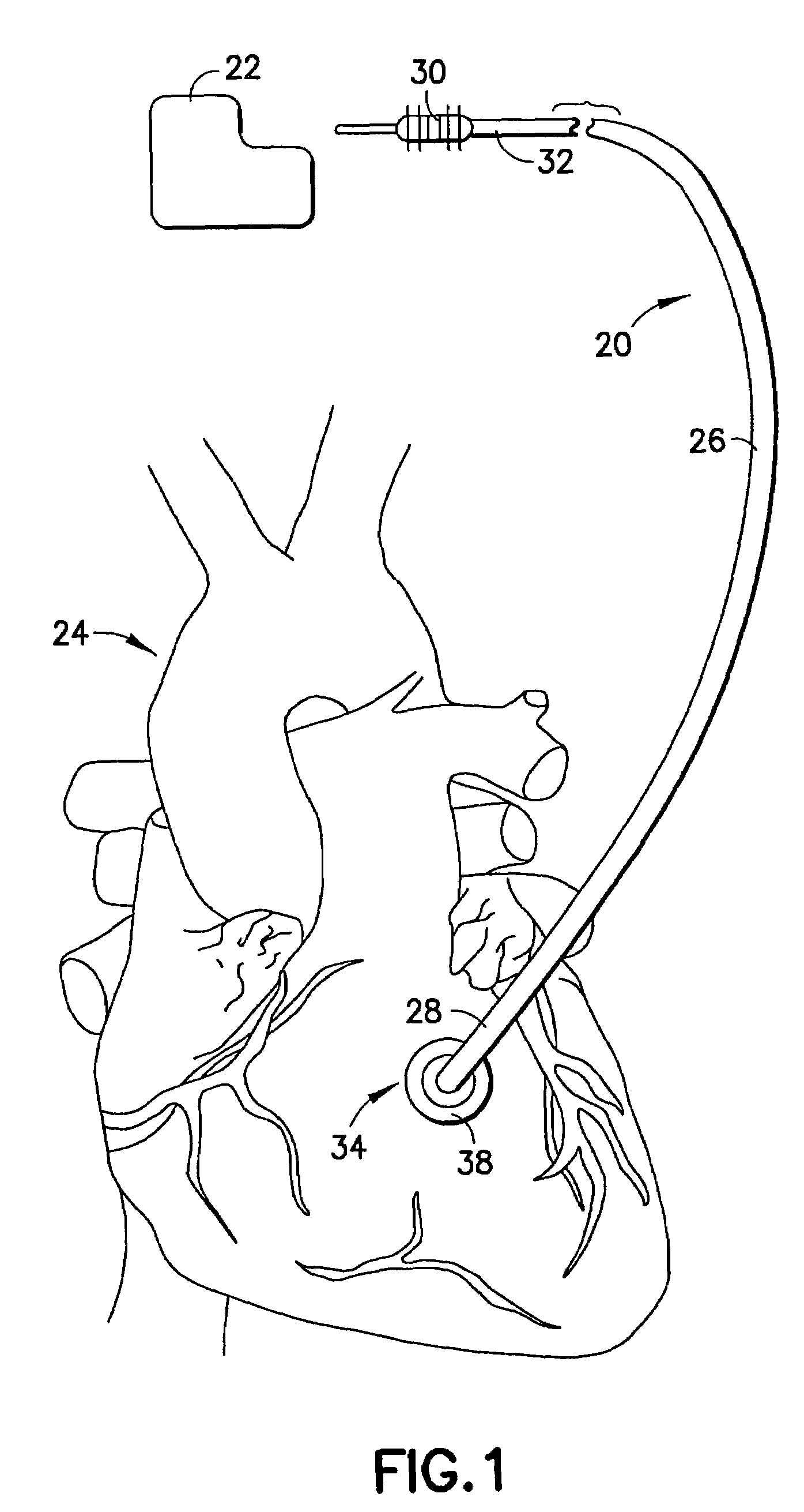 Epicardial and myocardial leads for implanting in the heart by thoracotomy or port access surgeries with detachable electrode tip