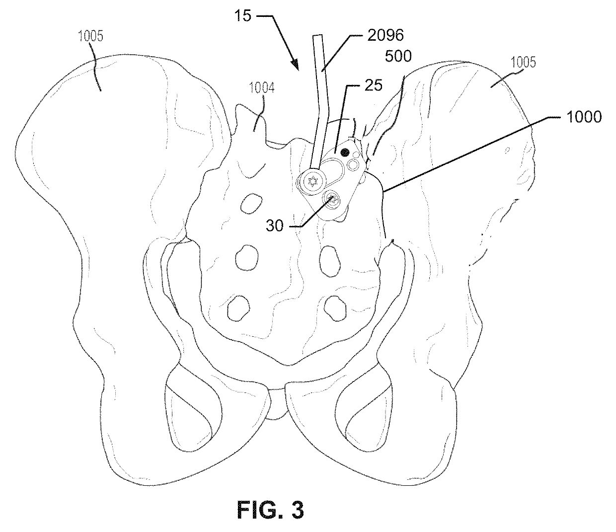 Systems and methods for fusing a sacroiliac joint and anchoring an orthopedic appliance