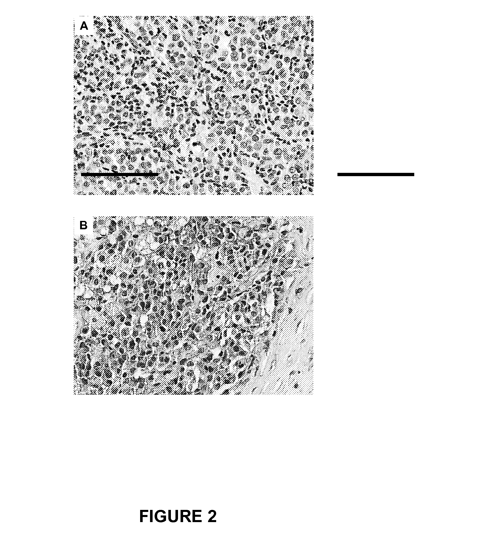 B7-h3 as a biomarker for diagnosing the progression and early lymph node metastasis of cancer