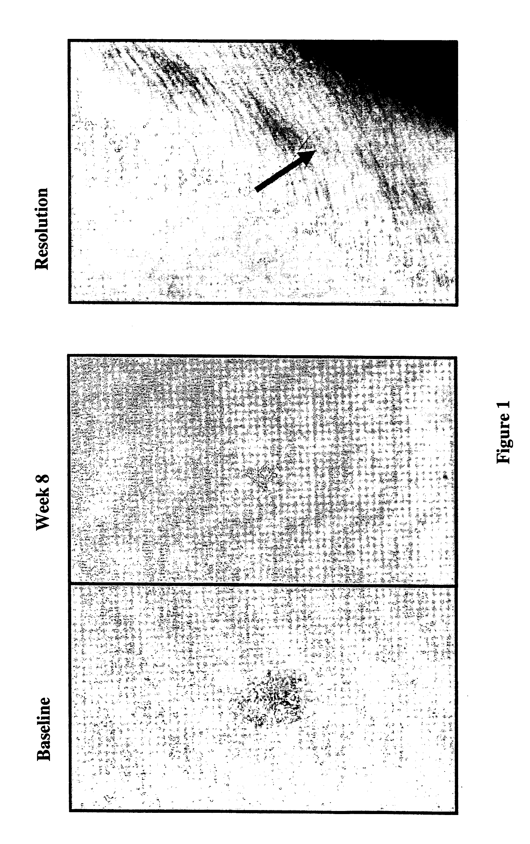 Methods of using and compositions comprising immunomodulatory compounds for the treatment and management of skin diseases or disorders