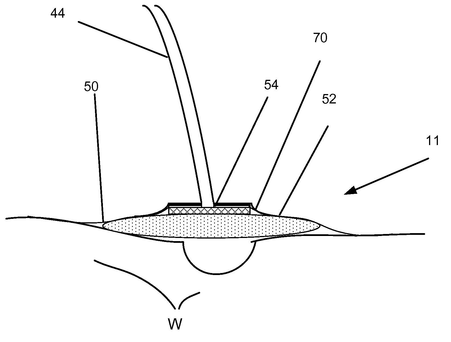 Pump leak monitor for negative pressure wound therapy