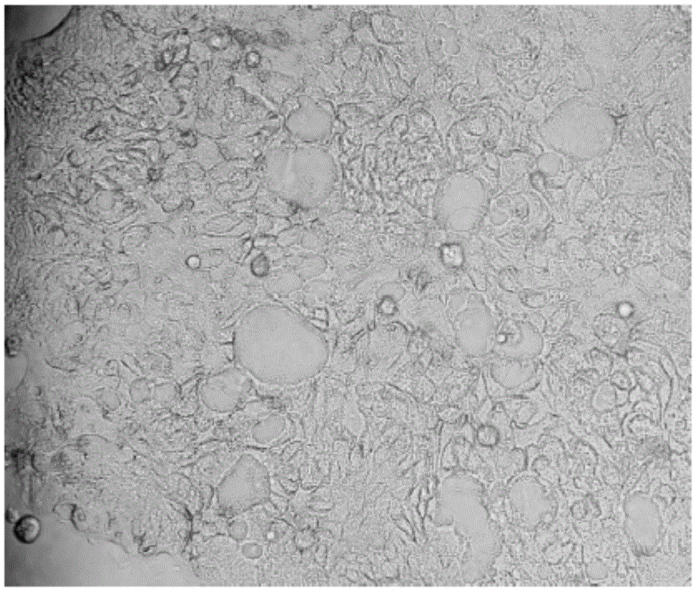 Human intrahepatic cholangiocarcinoma cell line with high tumorigenic ability and application thereof