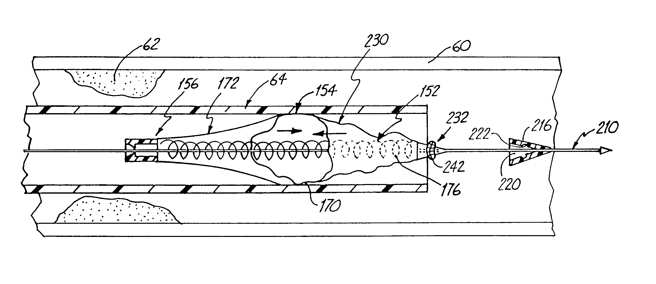 Distal protection device and method