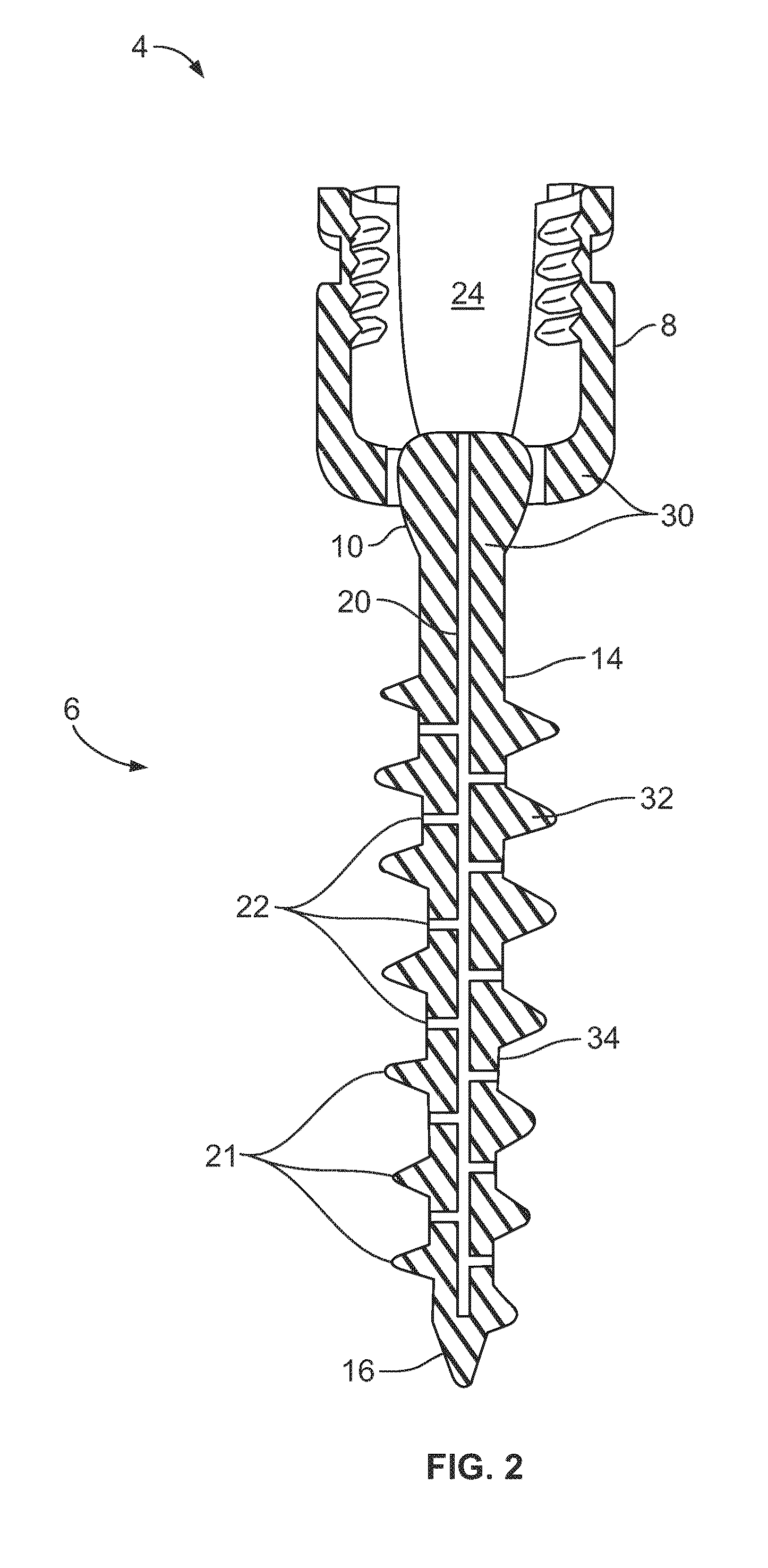 Composite Metal and Bone Orthopedic Fixation Devices