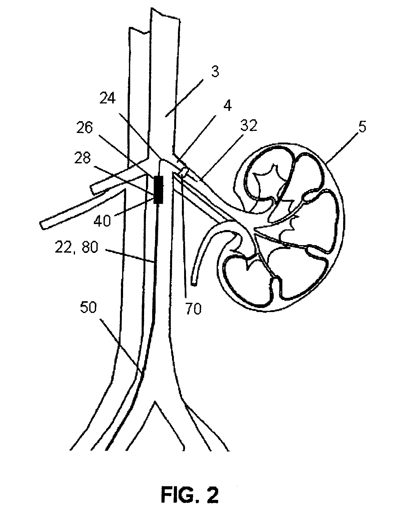 Method and Apparatus for Treatment of Congestive Heart Disease