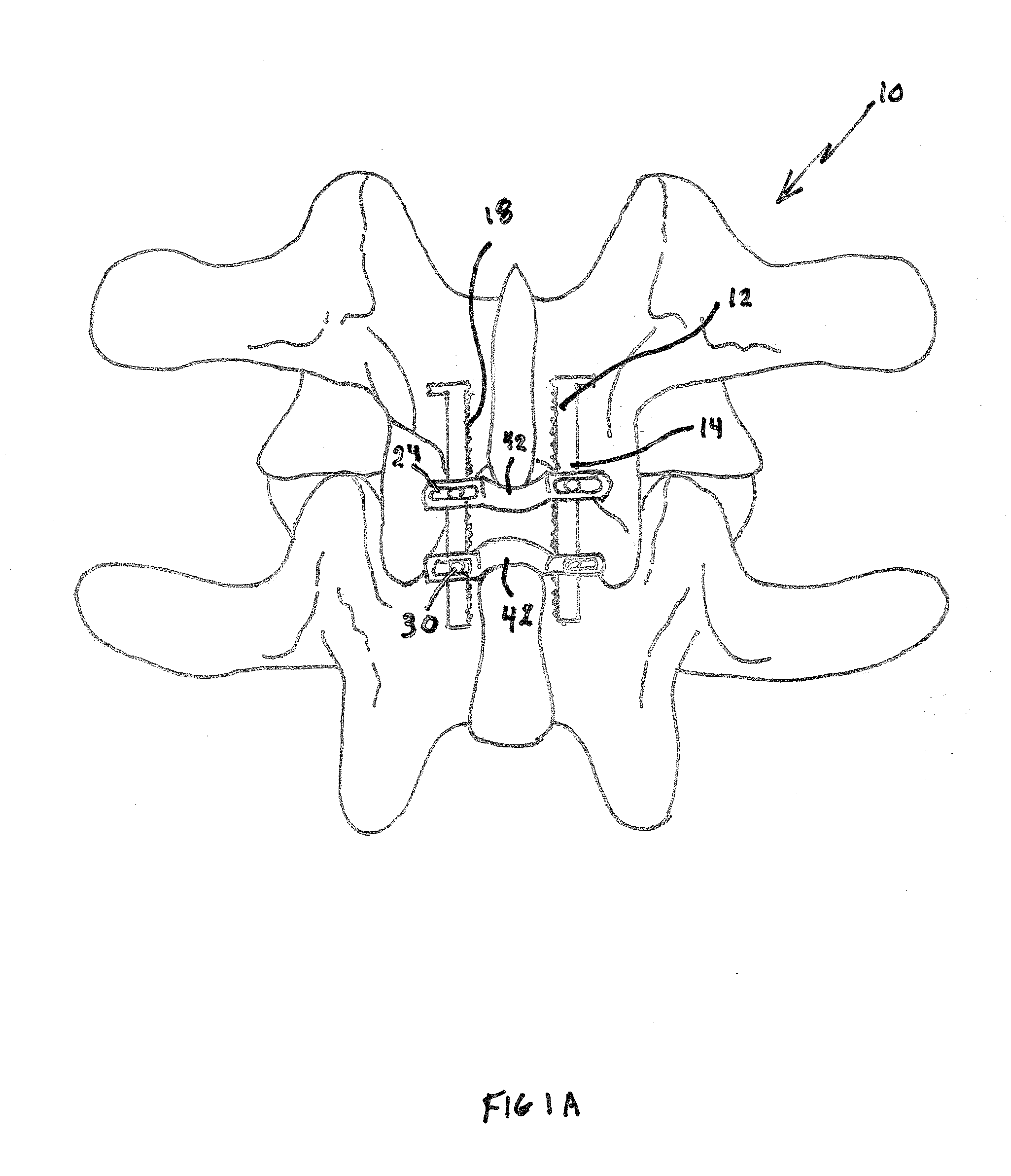 Adjustable spinous process spacer device and method of treating spinal disorders