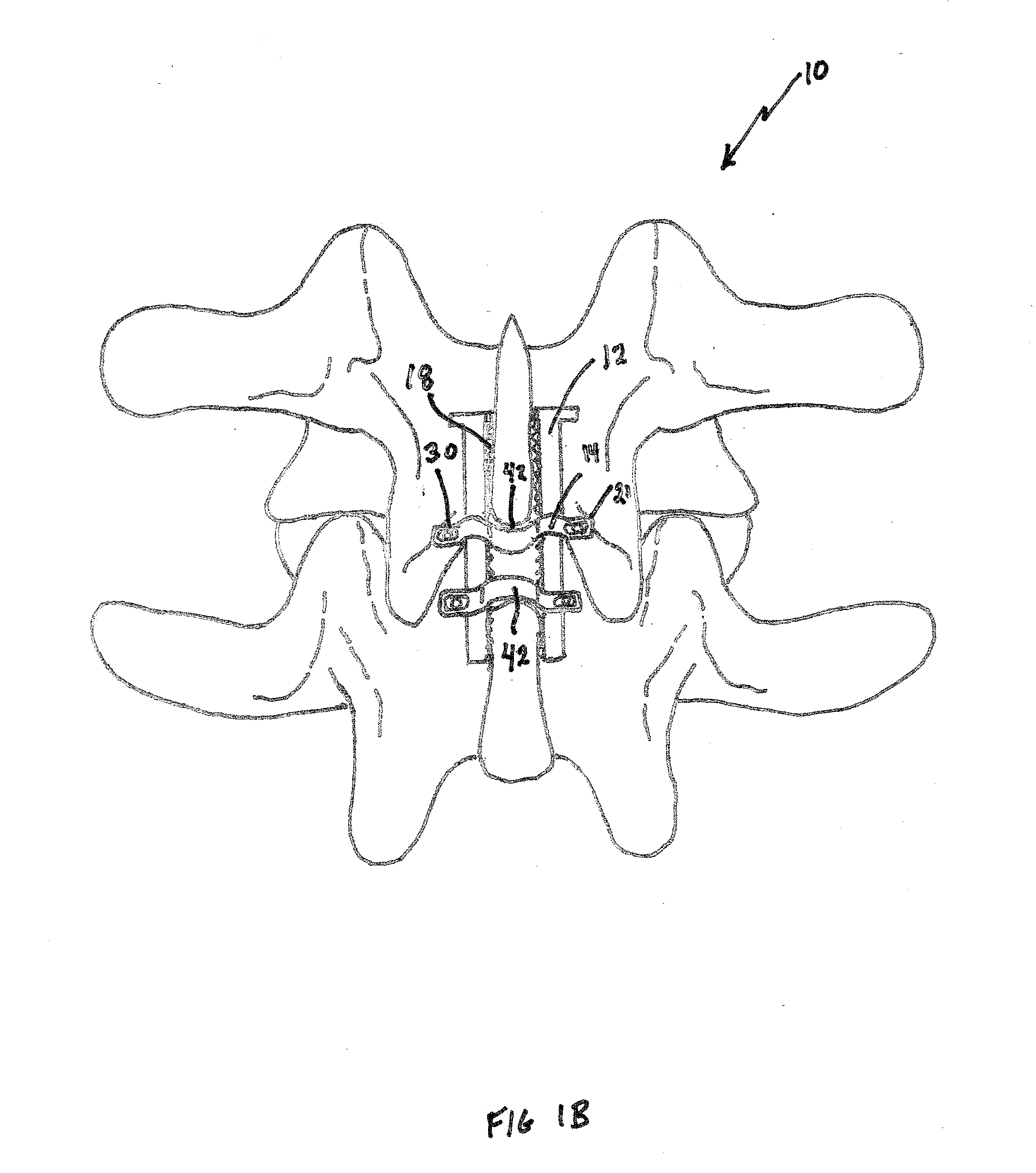 Adjustable spinous process spacer device and method of treating spinal disorders