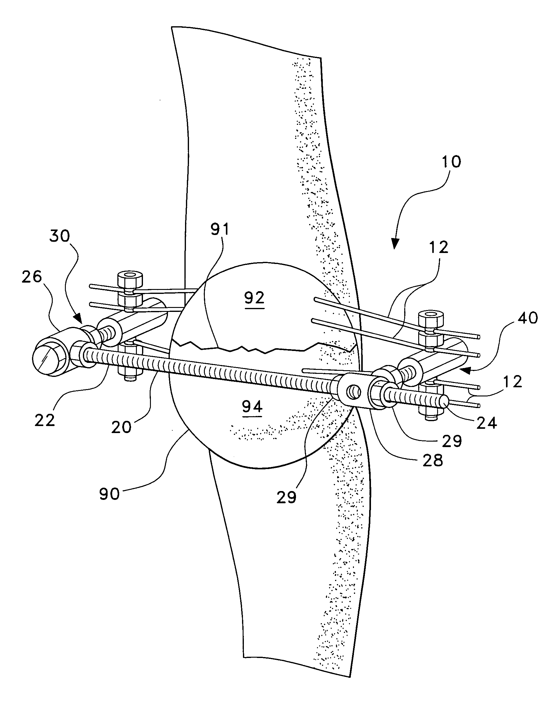 Method and apparatus for external fixation of bone fractures