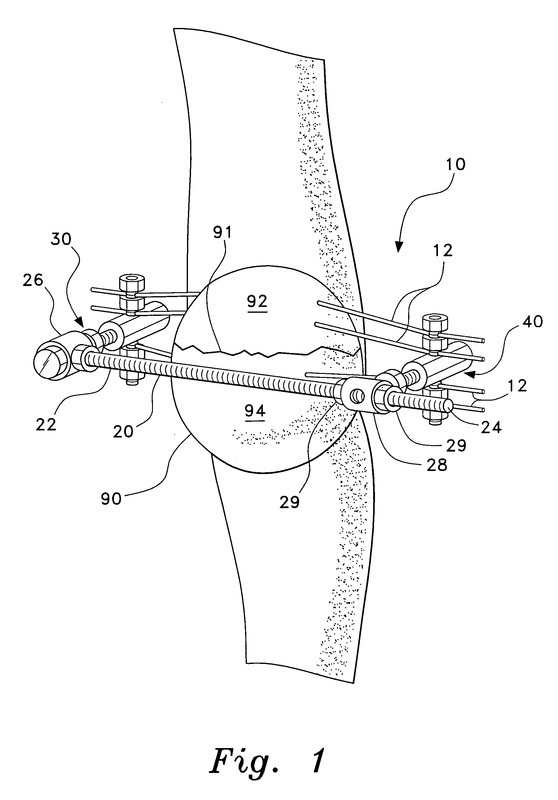 Method and apparatus for external fixation of bone fractures