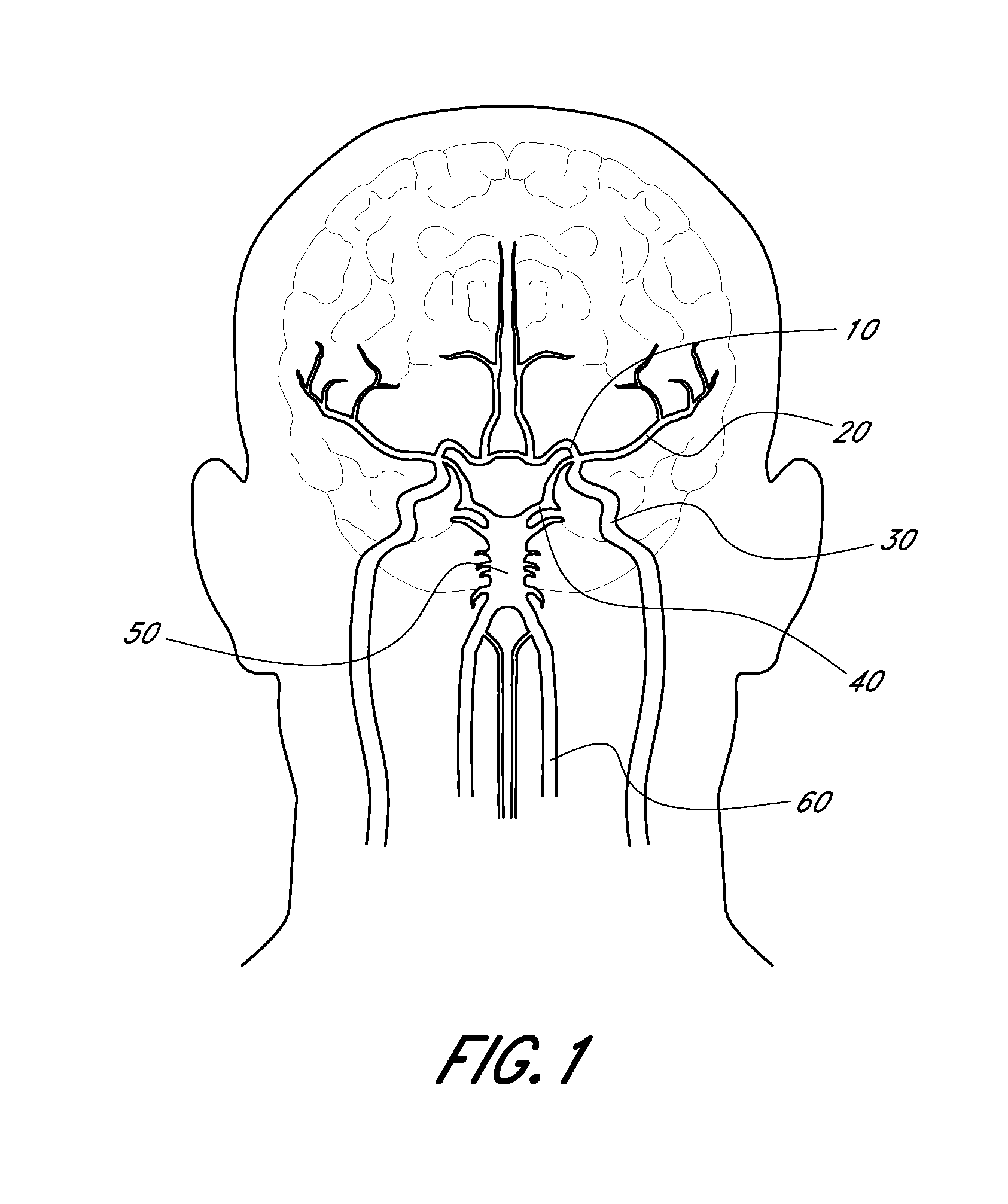 Method for providing progressive therapy for thrombus management