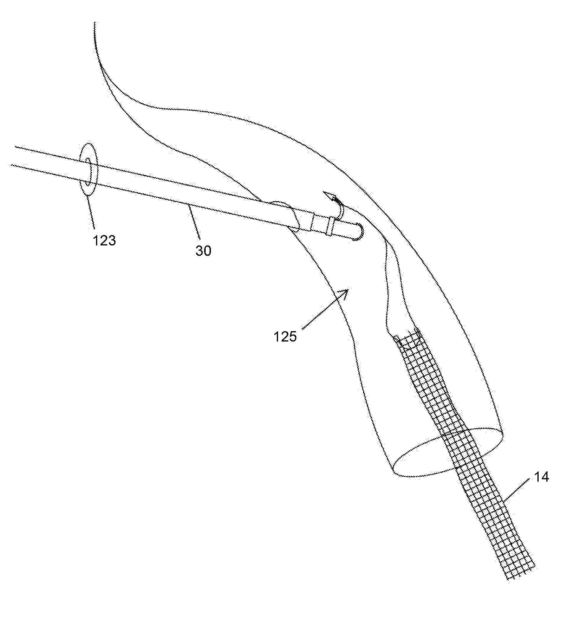 System and Method for Treating Prolapse and Incontinence