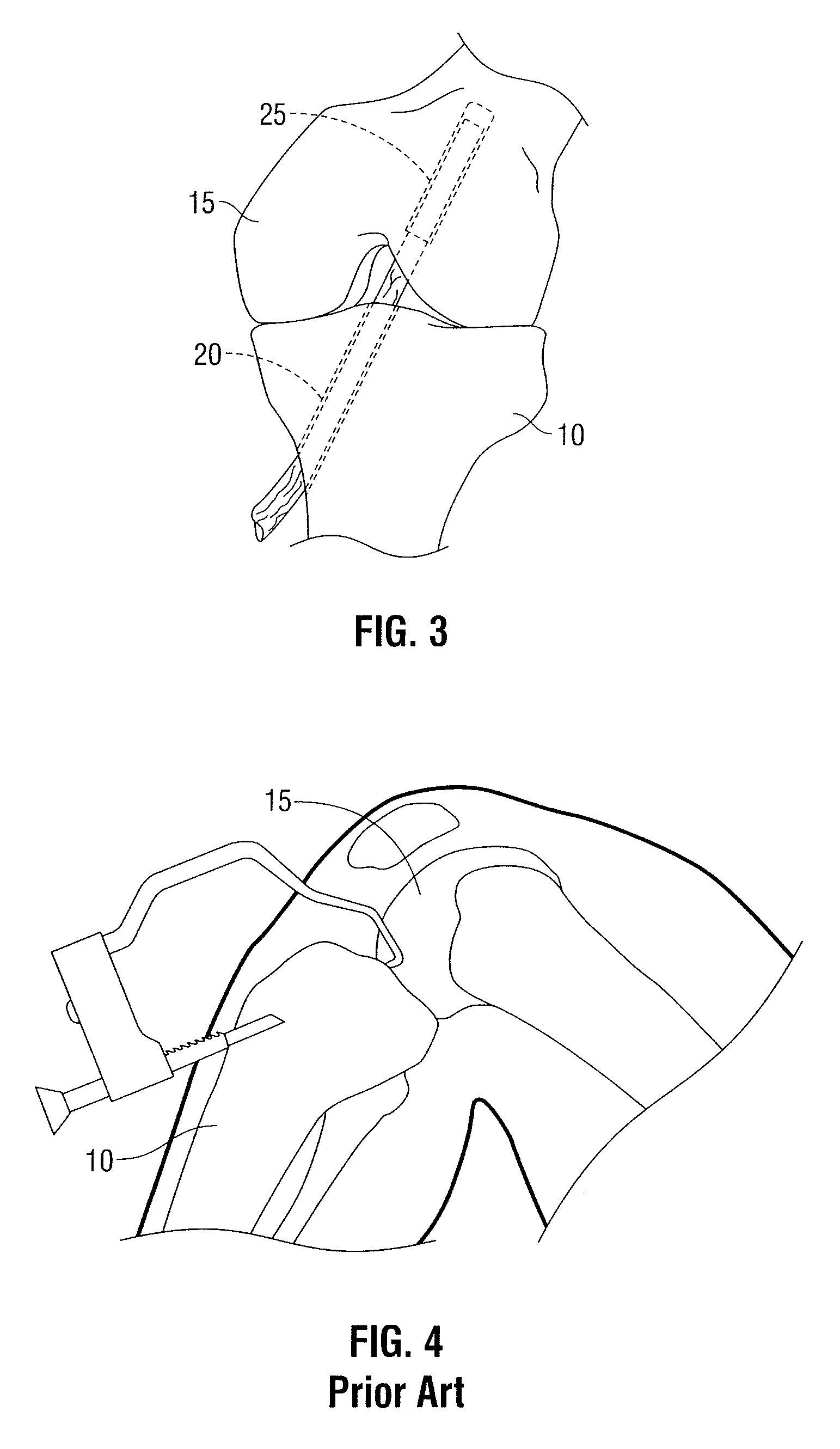 Tibial guide for acl repair having interchangeable and/or rotatable outrigger