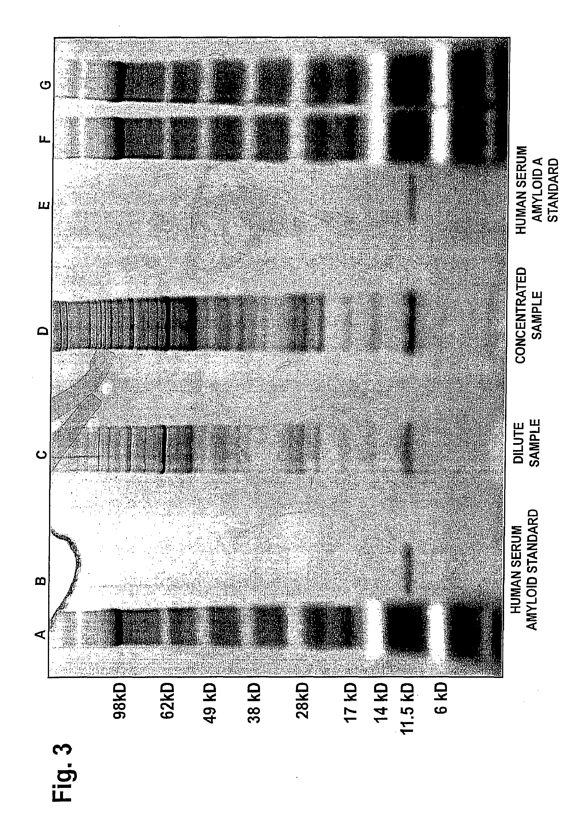 Methods And Marker Combinations For Screening For Predisposition To Lung Cancer
