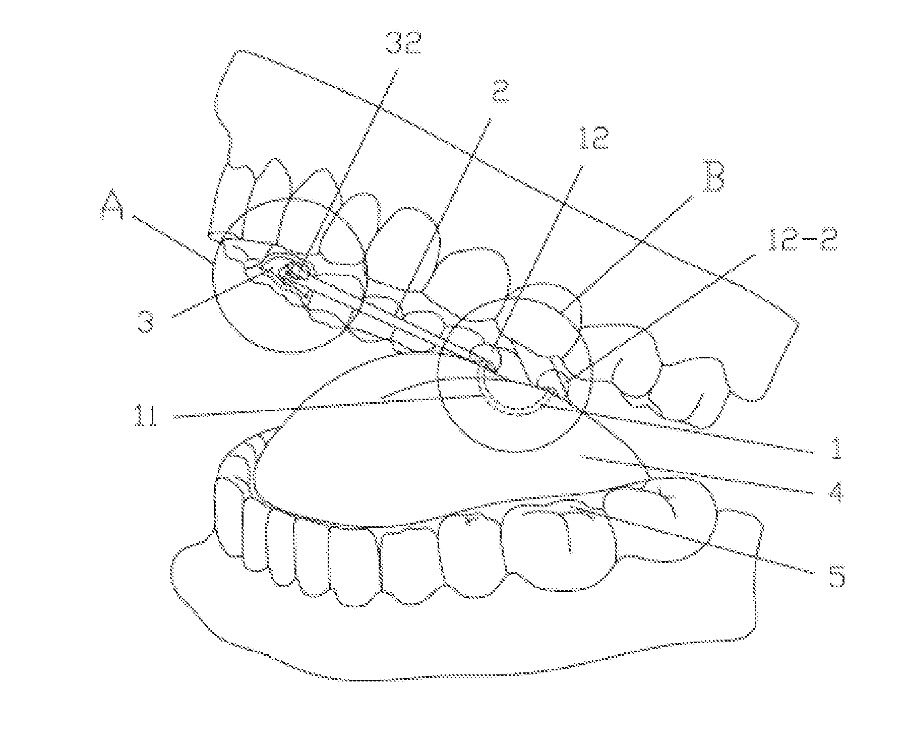 Elastic tongue-dorsum retraction device, clamping pliers, installation pliers, line guide and implantation method