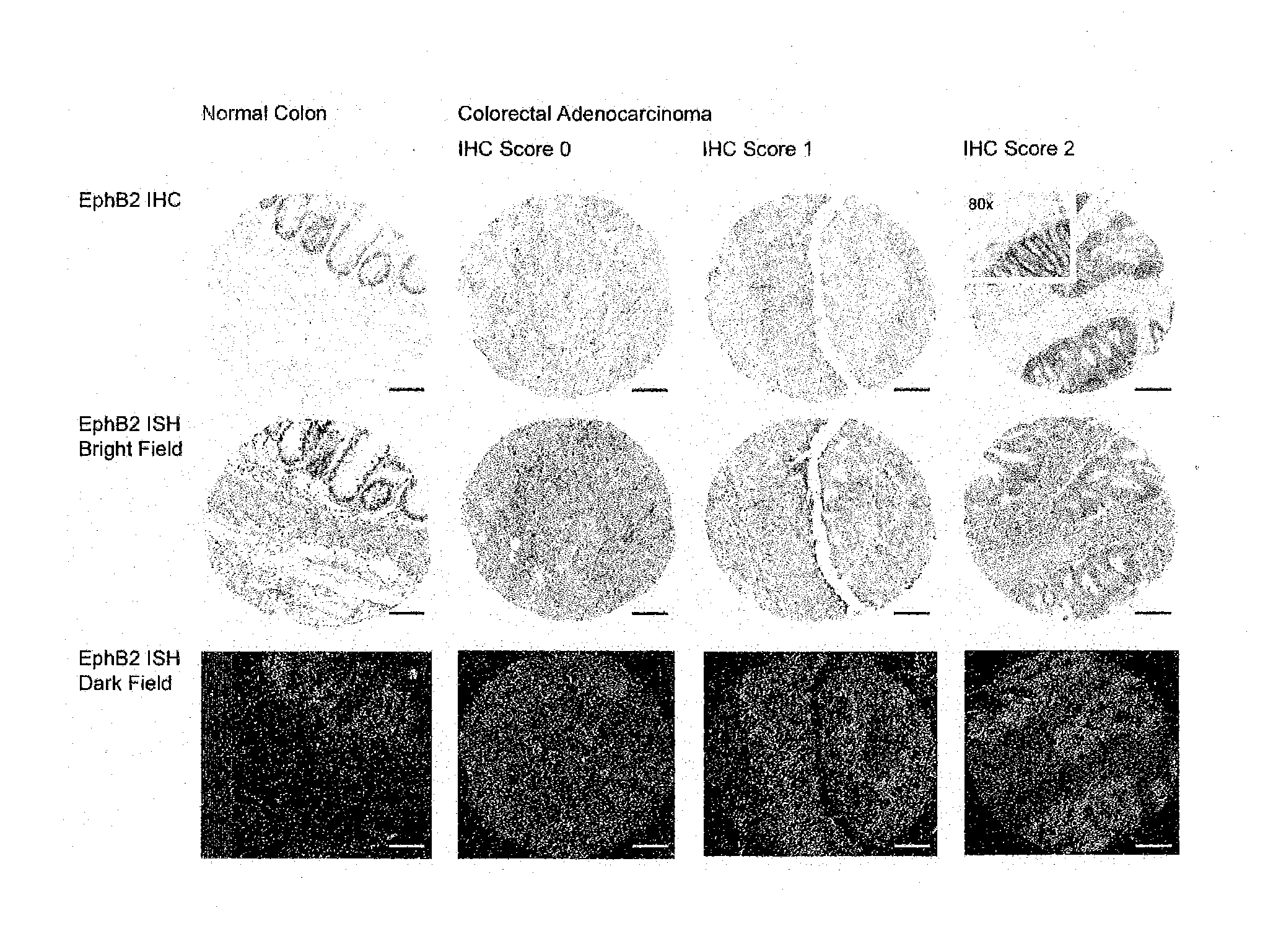 Cancer prognostic diagnostic and treatment methods