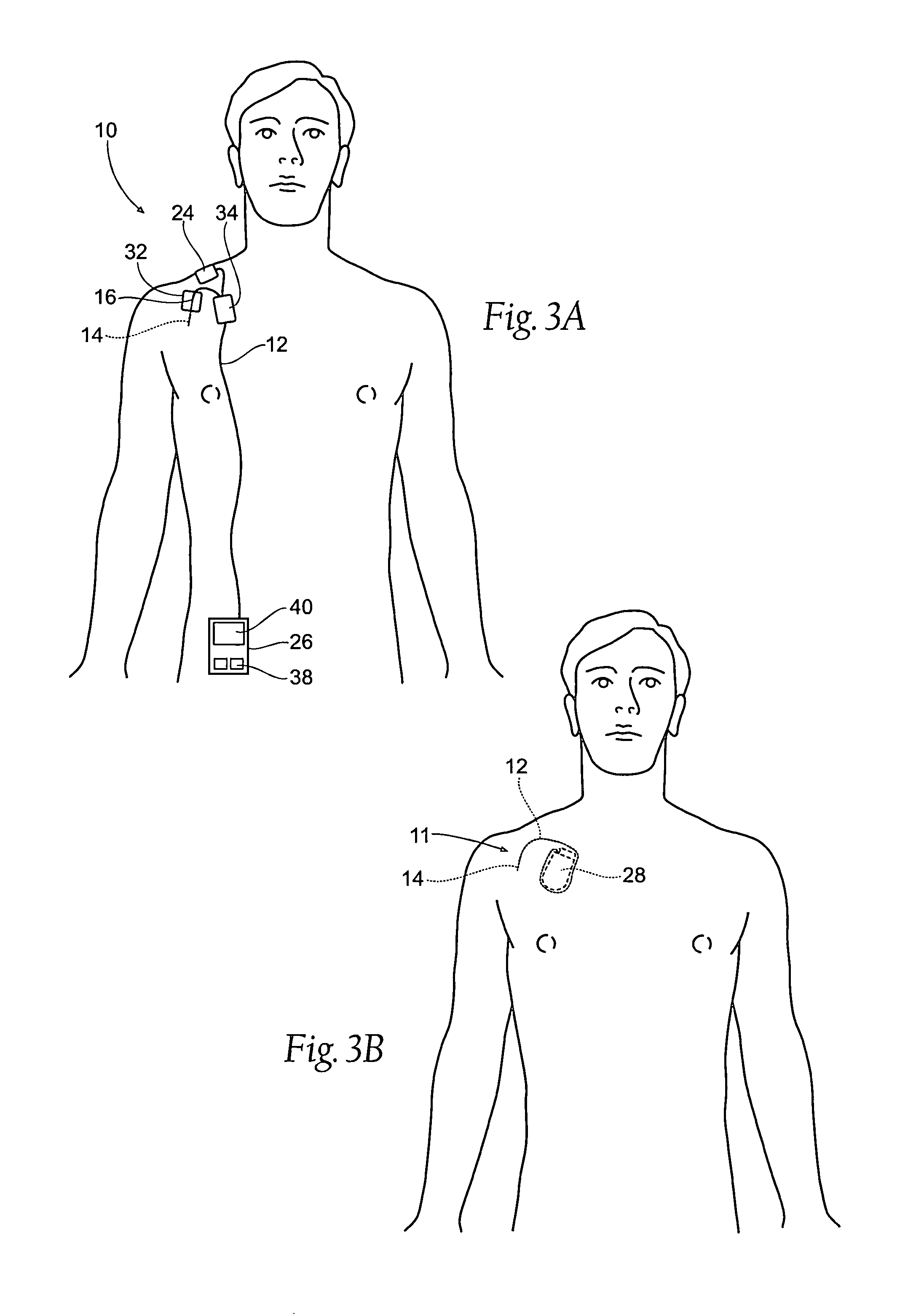 Systems and methods to place one or more leads in muscle for providing electrical stimulation to treat pain
