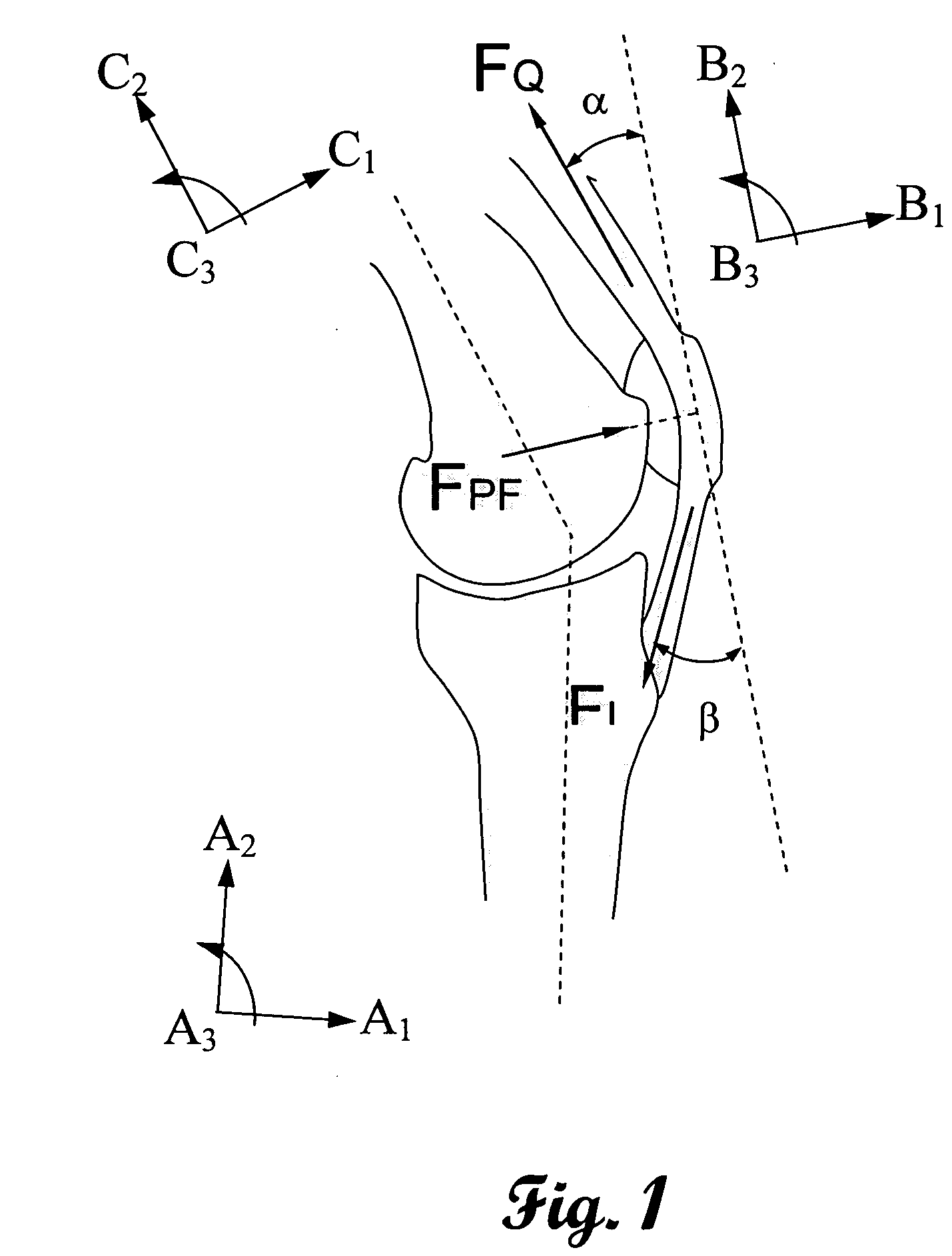 In-vivo orthopedic implant diagnostic device for sensing load, wear, and infection