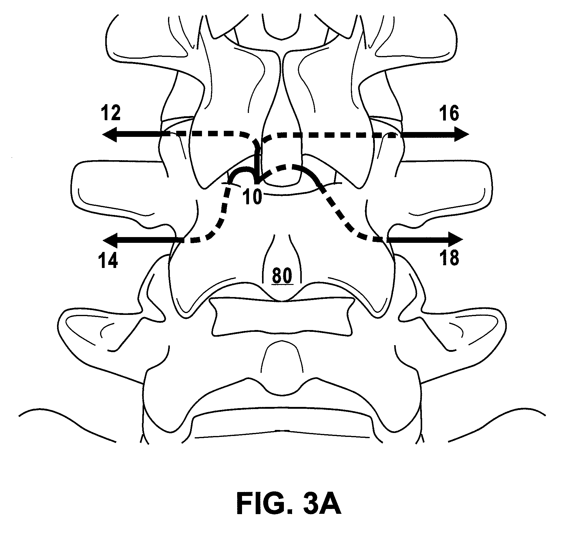 Multiple pathways for spinal nerve root decompression from a single access point