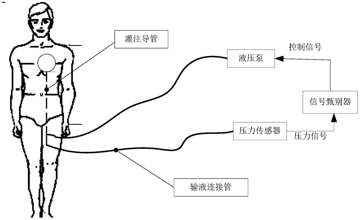 A cardiac in situ perfusion system based on pressure signal gating