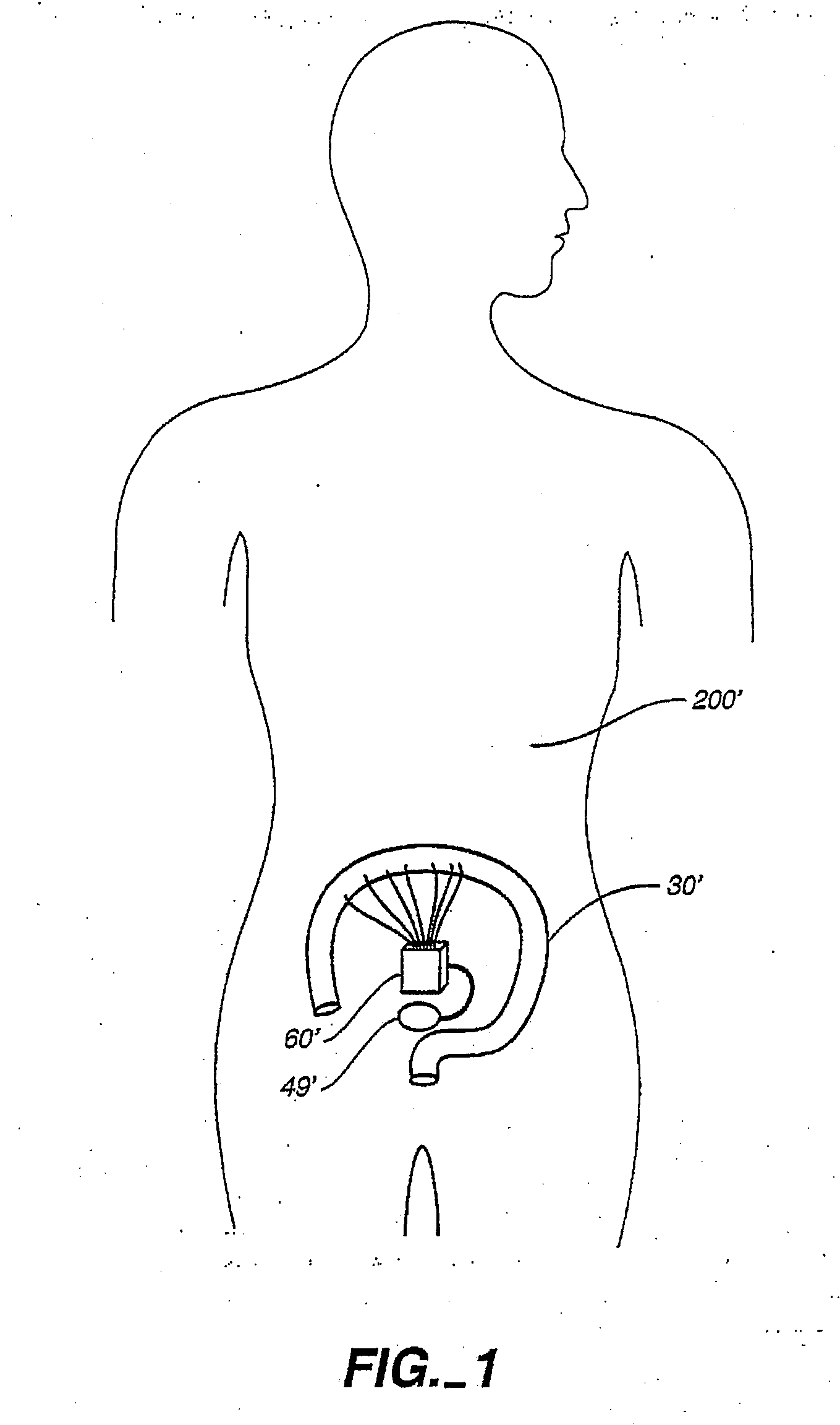 Implantable digestive tract organ