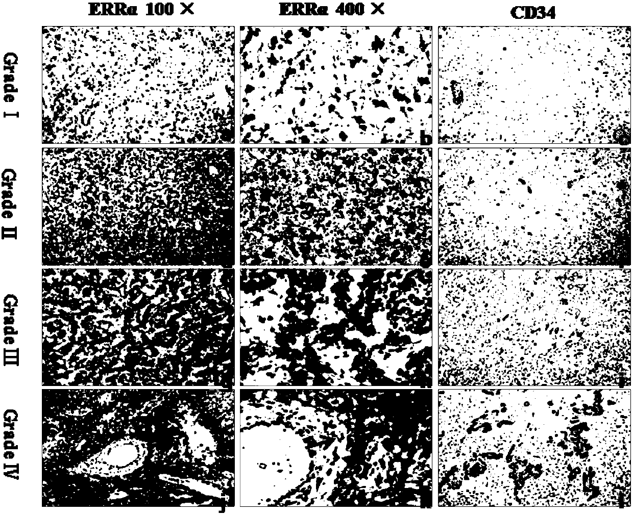 Use of estrogen-related receptor alpha as diagnostic marker for glioma and related application
