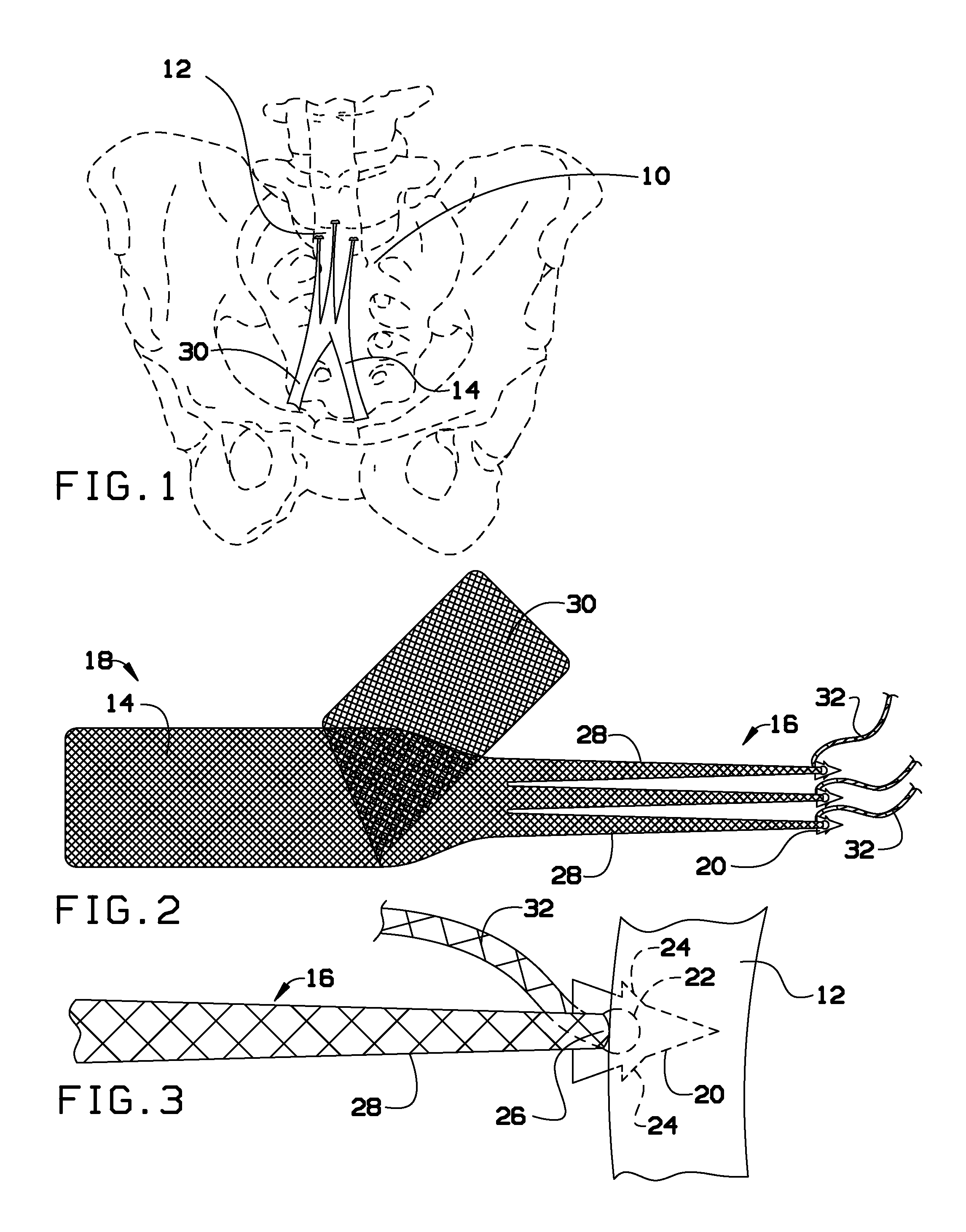 Surgical mesh for prolapse repair