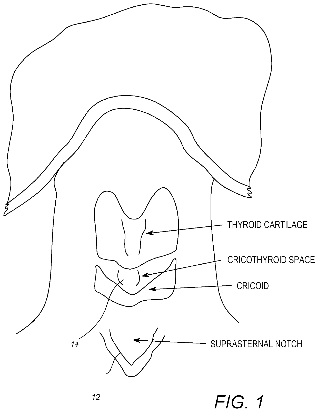 Cricotherotomy apparatus and method