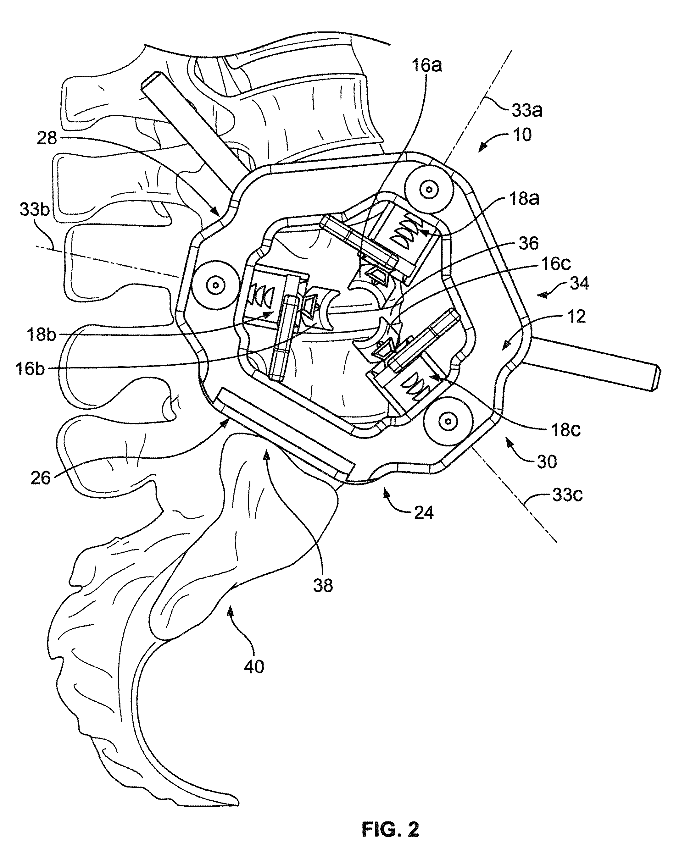 Retraction apparatus and method of use
