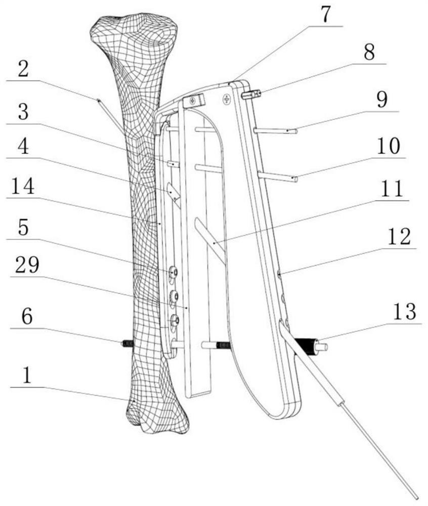 Navigation type minimally invasive bone setting system