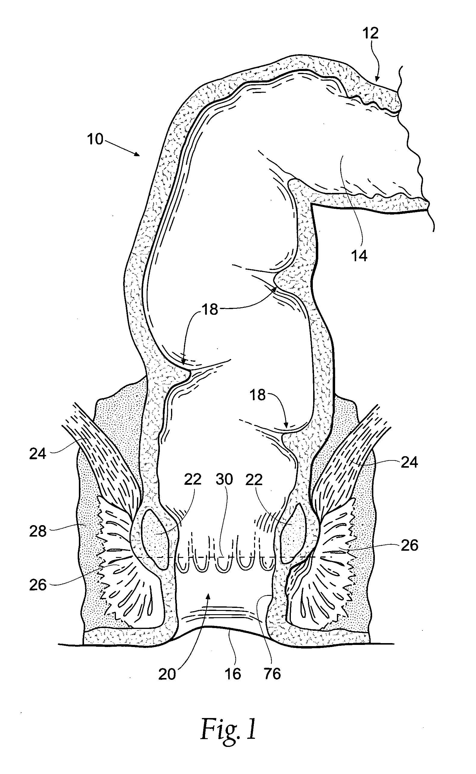 Systems and methods for treating dysfunctions in the intestines and rectum that adapt to the anatomic form and structure of different individuals