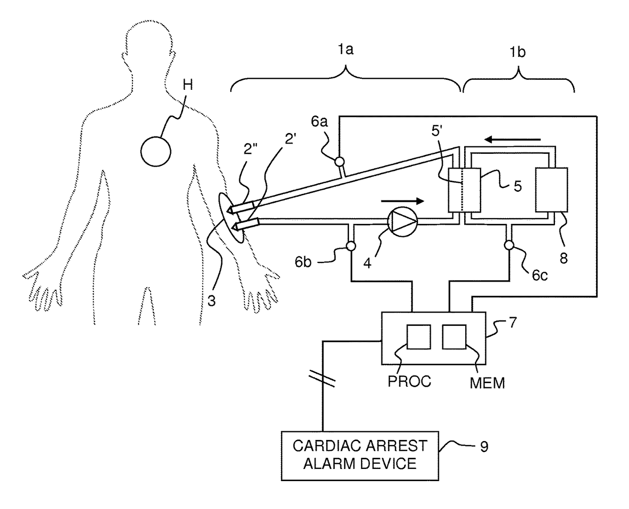 Monitoring of cardiac arrest in a patient connected to an extracorporeal blood processing apparatus