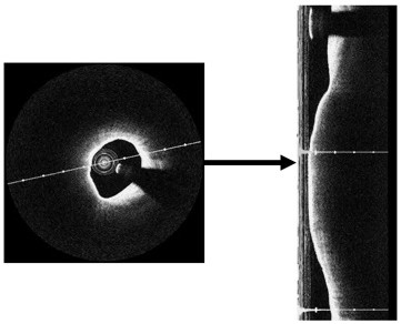 Method and device for detecting thin cap fibroplaque based on intracranial artery image